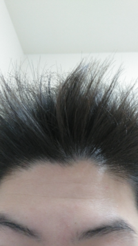 これはagaですか 一年前から前髪を上げると生え際から頭皮が透けて見えるよう Yahoo 知恵袋