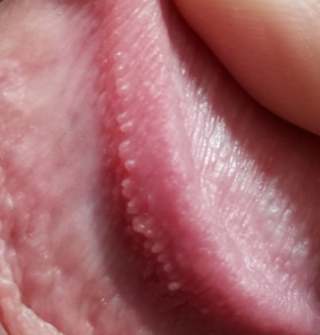 ぺ ニス 赤い 斑点 かゆく ない