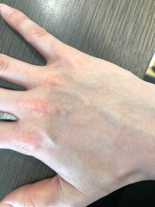 手の甲に突然赤い斑点ができました 痛くも痒くもありません 怖 Yahoo 知恵袋
