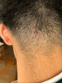 頭皮がチクチクしていたいんですけど何でなんでしょうか 3日くらいた Yahoo 知恵袋