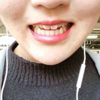 ほうれい線を消す方法 高校生の女子です ほうれい線が気になります なん Yahoo 知恵袋