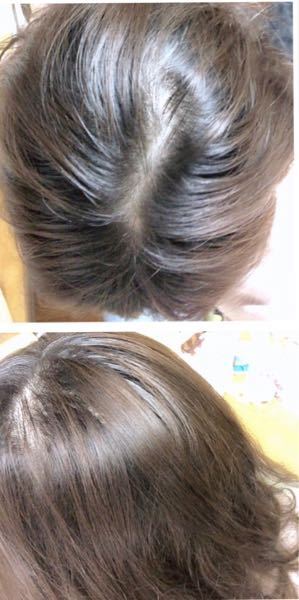 19歳女です つむじが薄い事に真剣に悩んでます これはや Yahoo 知恵袋