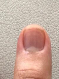爪甲色素線条またはメラノーマは複数の指の爪に出ることはありま Yahoo 知恵袋