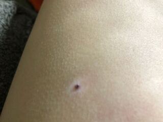 葡萄 嵐 咲く 脇腹 ほくろ Laccsda Org