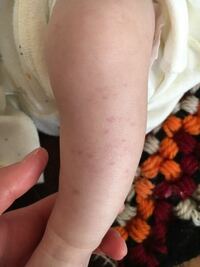 3ヶ月前の赤ちゃんですが お腹や足にポツポツした赤い斑点のようなものが Yahoo 知恵袋