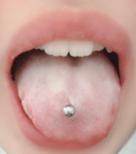 2月16日に舌ピを開けました。舌が白くなり舌の横がボコボコしていま 