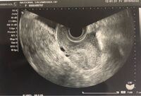 至急エコー写真に胎嚢が見えないと言われたのですが 見てください Yahoo 知恵袋