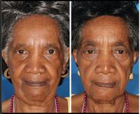 喉の痛み喉が片側だけ痛いです それも 風邪とは違う痛みで 唾を飲むのも痛いです Yahoo 知恵袋