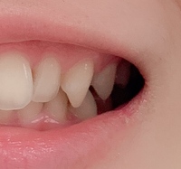 犬歯の尖りについて教えてください 上の歯が下の歯を覆うような噛み合 Yahoo 知恵袋