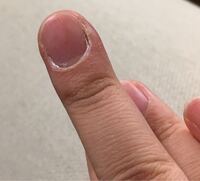 これは 爪周囲炎でしょうか 最初は単なる逆剥けか何かが原因かと思ってい Yahoo 知恵袋