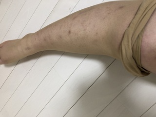 色素沈着 消す アトピー
