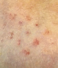皮膚に赤い斑点があります これは何の症状かわかりますか 保湿クリームを塗って Yahoo 知恵袋