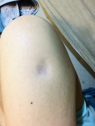 原因不明の皮膚の凹みについて 質問です 写真は左肩です 特に痛みはありません Yahoo 知恵袋