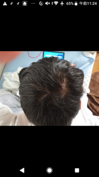 高校生で育毛剤を使うのは早いですか ちなみに17歳です Yahoo 知恵袋