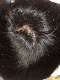 男子高校生です これって つむじはげですかね 本当にコ Yahoo 知恵袋