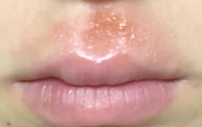 ポツポツ 唇 白い 唇に白いぶつぶつが出来る原因と対処法6選