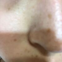 高校生です日焼けでそばかす シミが大量に出来て消したいです 元々色白なので Yahoo 知恵袋