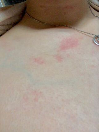 お 風呂 上がり 湿疹 お風呂上がりに湿疹