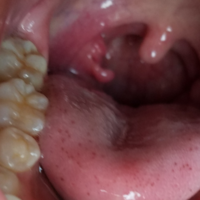 同一の 反対 マトン 口蓋 扁桃 違和感 子供っぽい コンデンサー 備品