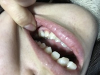 歯茎にこのような黒いものが出来ていました少しズキズキした痛みがあります 直ぐ Yahoo 知恵袋