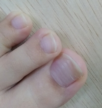 画像注意足の爪の凹凸について去年の9月頃 足指のすべての爪が横に Yahoo 知恵袋