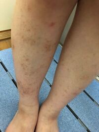 カミソリ負けで赤みは取れたのですが 黒ずみがなかなか治りませ Yahoo 知恵袋