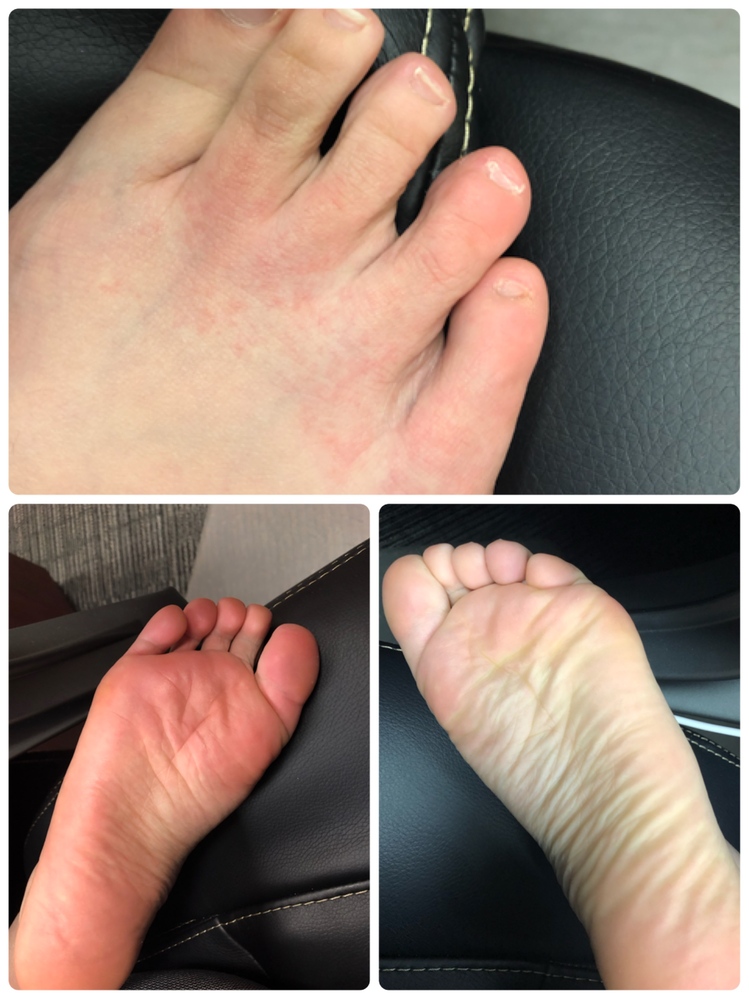 足 の 指 かゆみ 腫れ 指の関節が腫れて痛みやかゆみが出る原因と対処法について Amp Petmd Com