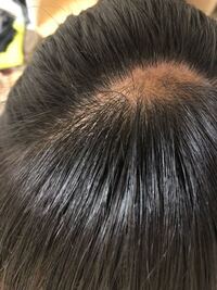 若白髪がすごくて悩んでます 高校1年女子なのですが すごく若白髪が多いで Yahoo 知恵袋