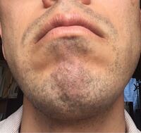 これはヒゲが濃い方ですか 脱毛すると毎日のヒゲ剃りが楽になりますか Yahoo 知恵袋