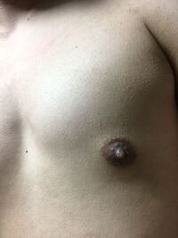 男子高校生です これは女性化乳房ですか 小学生の頃は肥満体型でした今 Yahoo 知恵袋