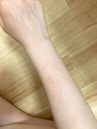 閲覧注意これはなんですか もともと毛の剃りすぎで毛穴が盛り上がりぶ Yahoo 知恵袋