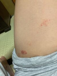 画像あり この内ももにできた赤いのはなんでしょうか だいぶ前に出来て Yahoo 知恵袋