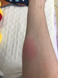 朝起きたら虫に刺されたような感じになってました これはなんの虫でしょうか 虫では 教えて 住まいの先生 Yahoo 不動産