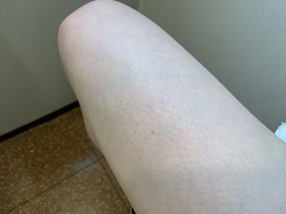 これは梅毒ですか それともほかの病気の可能性はありますか 痛み痒みはありませ Yahoo 知恵袋