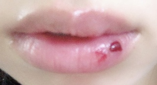 画像あり 唇の血豆 夜中赤ちゃんの頭とごっつんこして 朝起きたら唇に結構お Yahoo 知恵袋