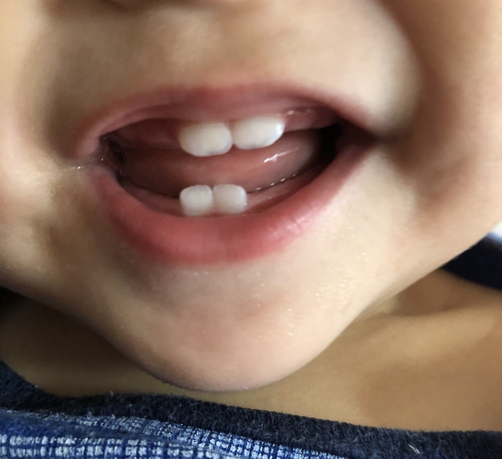 10ヶ月の赤ちゃんの前歯の上と下の位置がおかしくないですか 今日なんだか歯と Yahoo 知恵袋