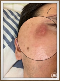 顔の傷跡が残らないようにしたいです この前駐車場で転けて怪我をしました 眉毛 Yahoo 知恵袋