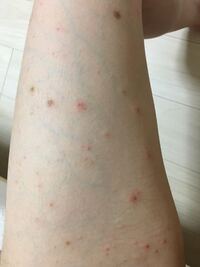 汚い画像すみません 太ももやふくらはぎ 腕や下腹などのいたる Yahoo 知恵袋