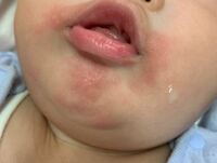 いきなりミルクアレルギーになることってありますか 5ヶ月半の赤ちゃんですが Yahoo 知恵袋