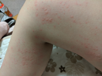 昨日のお昼ご飯を食べたあとから 太ももが痒く 家に帰りお風呂に Yahoo 知恵袋