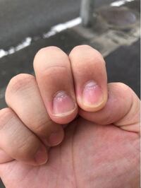 爪がおかしい 今日何となく爪を見てたらこんな感じに根本の方がボ Yahoo 知恵袋