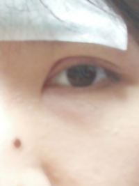 埋没が取れてしまったのでしょうか 二重糸が切れてしまったのか Yahoo 知恵袋