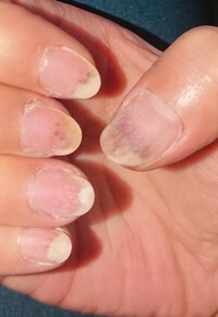 初めて爪甲剥離症になりました。
もう何年もジェルネイルをしていますが3ヶ月前に新人のネイリストに当たりペラペラになるまで爪を削られ、次にネイルをしに行った時に爪下出血していました。 その時は気にせずに削りすぎないようにしてくださいとネイリストに告げてネイルを付け替えました。
その後、爪と皮膚の間が空いていき、固い皮膚が爪の裏にもじゃもじゃと出てきました。
それでも気にせずにまたネイルを...