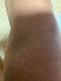 膝に写真のようなぶつぶつができたのですが 原因と治療方法を教えてく Yahoo 知恵袋