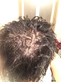 18歳です。 最近髪の毛がよく抜けます

なんとなく頭皮を写真撮ってみるの禿げてました。
ショックすぎて泣いてしまうほどです

本当に辛いです

これは禿げてますよね。

どうしたら治りますか、