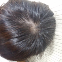 アラサーの女です 最近 分け目ハゲが気になってきました 髪の毛を結ぶと Yahoo 知恵袋