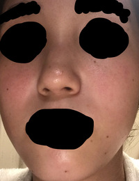 汚い写真ですみません ほくろ多い方ですか ほくろが気になってます Yahoo 知恵袋