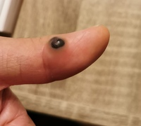 指に血豆の様なものが出来てから2ヶ月ぐらい経ちましたが日に日に大き Yahoo 知恵袋