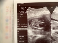こんにちは 18週のエコー写真です 性別が知りたいです 先生は多分男の子とは Yahoo 知恵袋