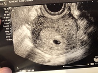 不順なので何周目かは分からないのですが胎嚢の大きさは１センチです Yahoo 知恵袋